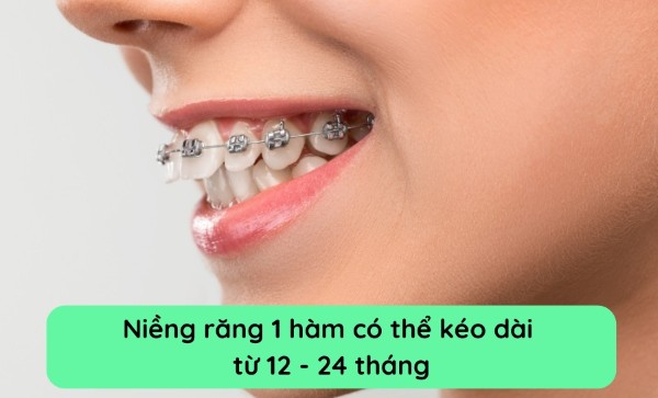 Thời gian niềng răng 1 hàm mất bao lâu