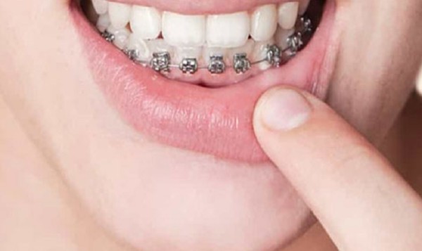 Các yếu tố ảnh hưởng đến thời gian niềng răng 1 hàm mất bao lâu