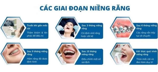 Quy trình và thời gian các giai đoạn niềng răng 1 hàm