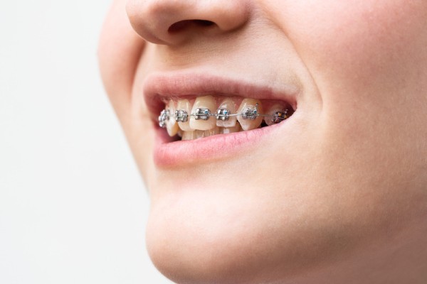 Các câu hỏi về thời gian niềng răng 1 hàm mất bao lâu