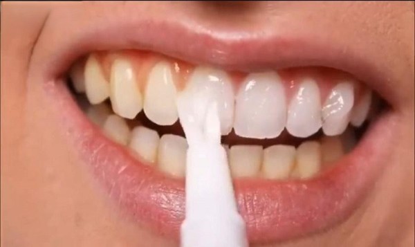 Thuốc tẩy trắng và tác động lên men răng làm răng bị e buốt