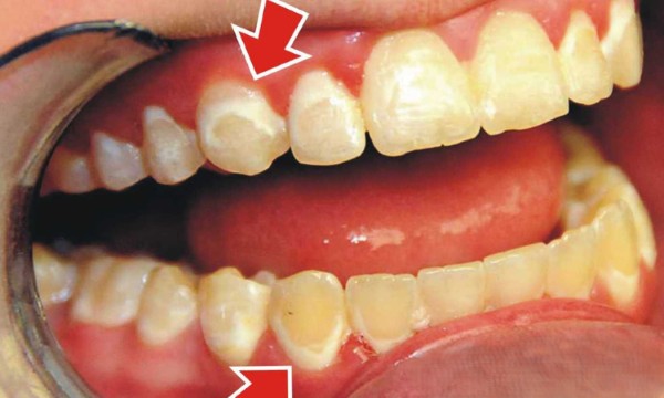 Các yếu tố làm tăng nguy cơ ê buốt khi tẩy trắng răng