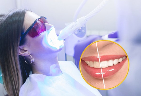 Một số câu hỏi thường gặp liên quan đến việc tẩy trắng răng có bị ê buốt không
