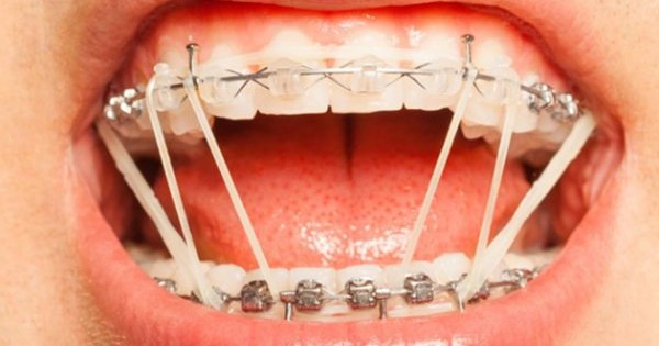 Thun niềng răng hay còn gọi là elastics