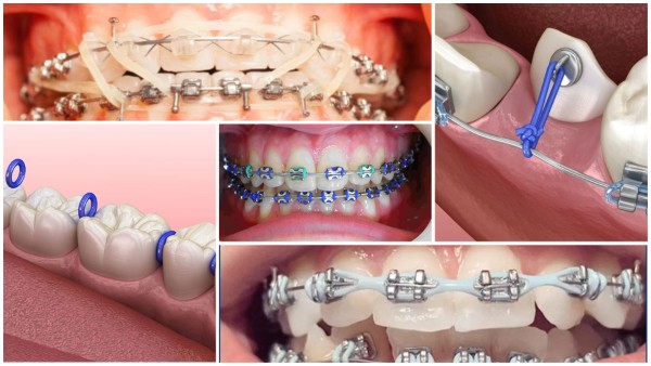 Các loại thun niềng răng phổ biến 