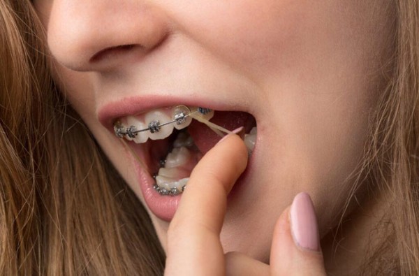 Một trong những trải nghiệm không thể tránh khỏi khi đeo thun niềng răng là cảm giác khó chịu và đau đớn