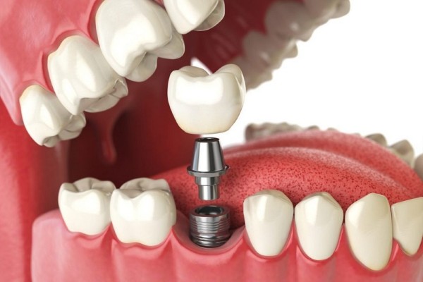 Trồng răng Implant là gì?