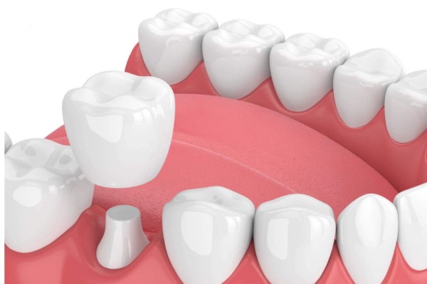 Bọc răng sứ là một phương pháp phục hình nha khoa