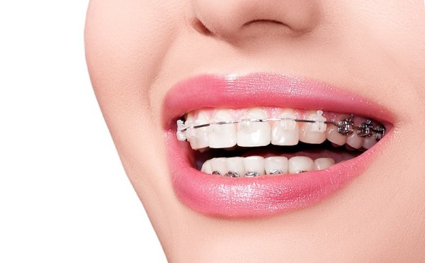 Những rủi ro và lưu ý đặc biệt khi niềng răng trên răng sứ