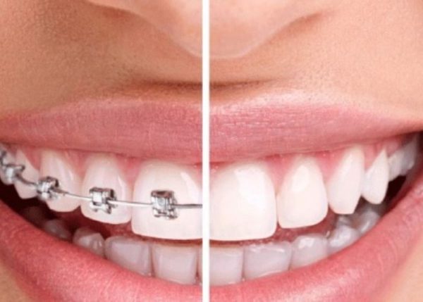 Bọc răng sứ có niềng răng được không?