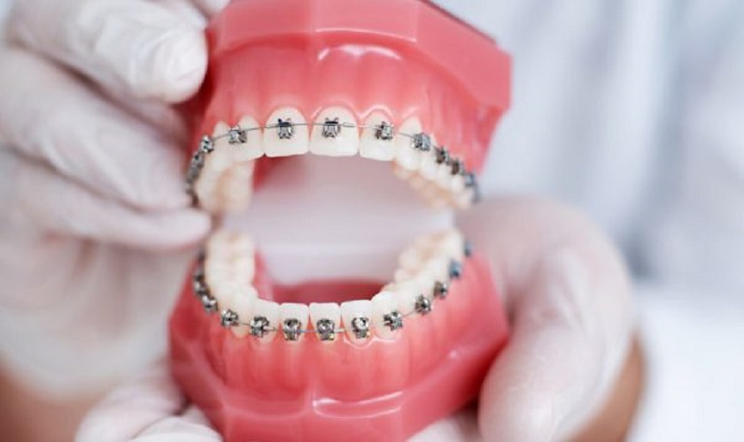 Niềng răng được định nghĩa là một phương pháp chỉnh hình nha khoa