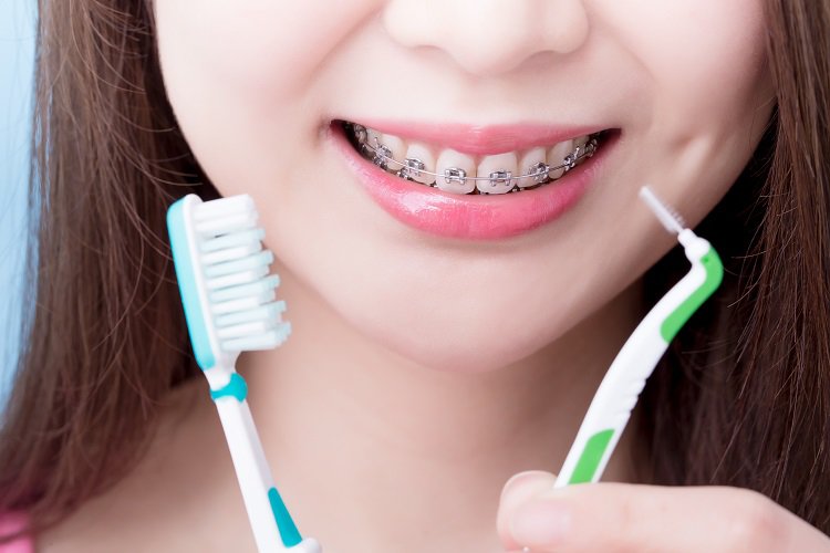 Lưu ý đặc biệt khi chăm sóc răng trong các giai đoạn niềng răng
