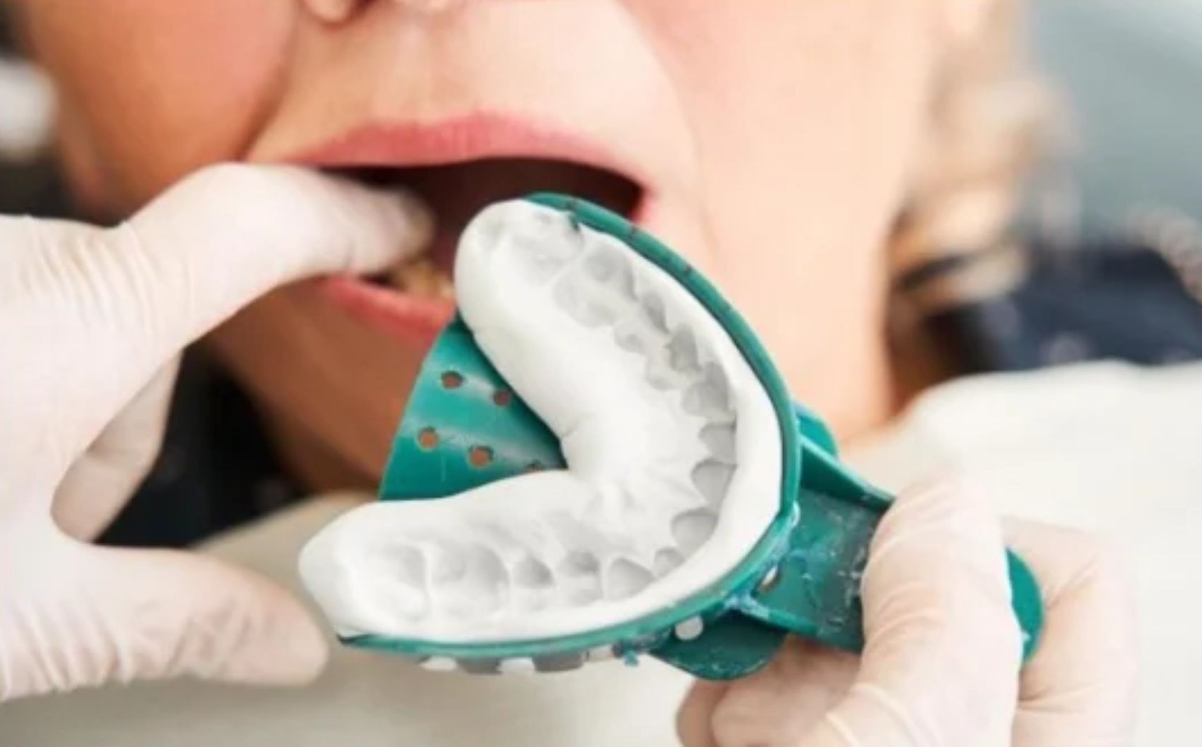 Giai đoạn chuẩn bị trước gắn khí cụ chỉnh nha