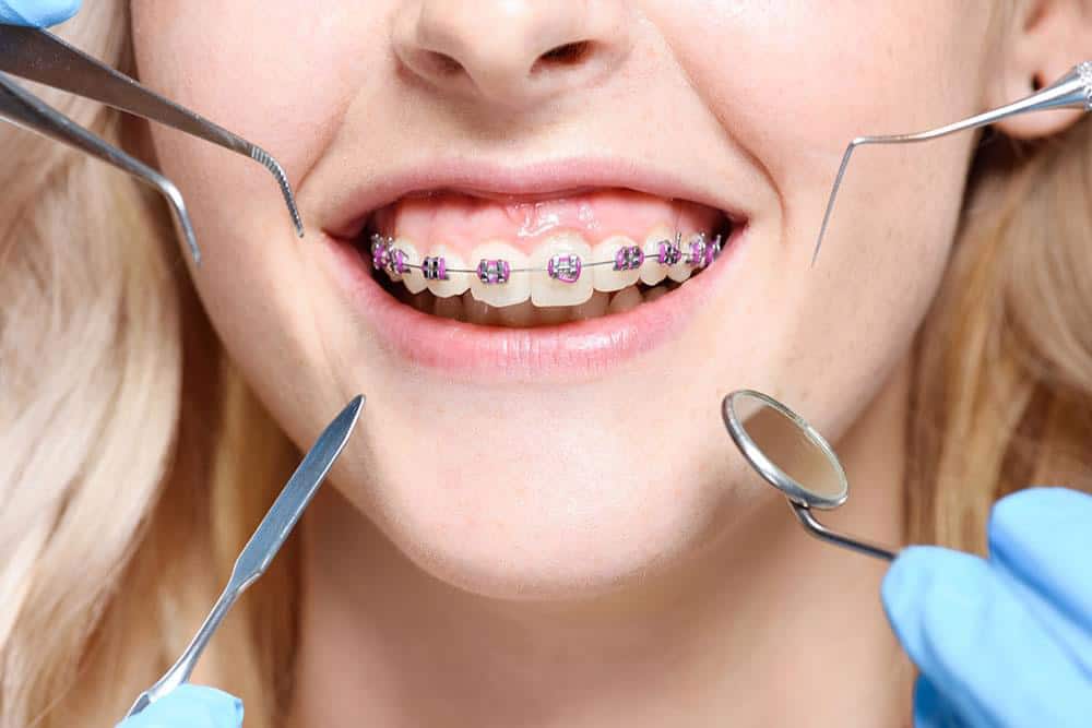 Giai đoạn gắn khí cụ chỉnh nha