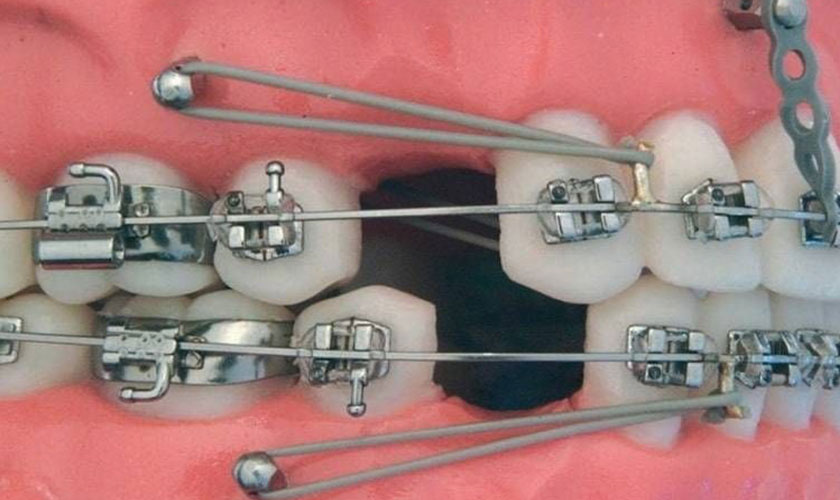 Giai đoạn làm đều răng – dịch chuyển răng ban đầu