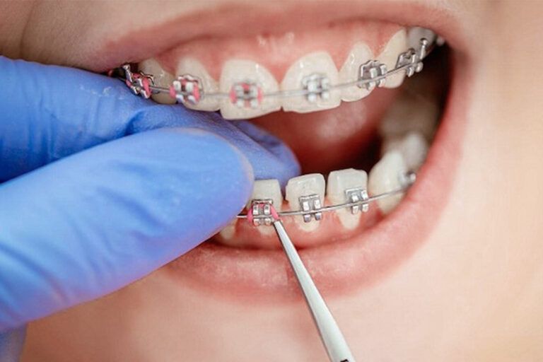 Giai đoạn tháo khí cụ chỉnh nha