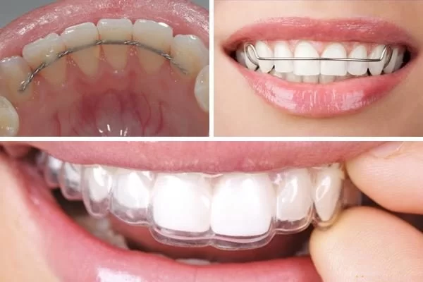 Giai đoạn duy trì sau niềng răng