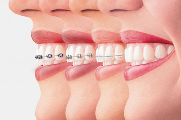 Các yếu tố ảnh hưởng đến tốc độ và hiệu quả của các giai đoạn niềng răng