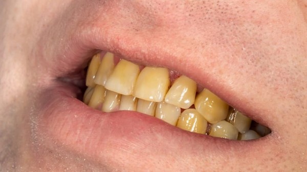 Các yếu tố chủ yếu dẫn đến tình trạng răng ố vàng