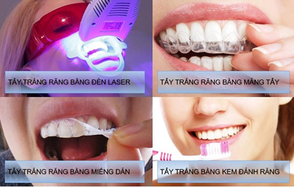 Tổng quan các phương pháp tẩy trắng răng