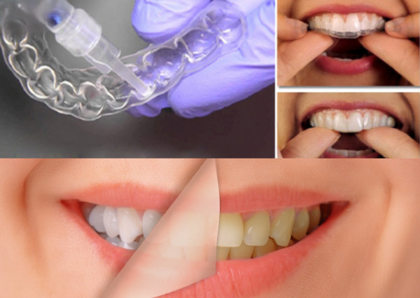 Cách tẩy trắng răng ố vàng bằng các sản phẩm tẩy trắng răng không kê đơn OTC