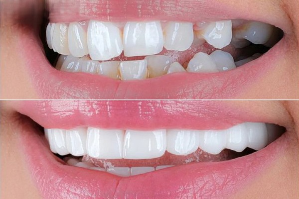 Bọc răng sứ là một trong những cách chỉnh răng mọc lệch không cần niềng phổ biến