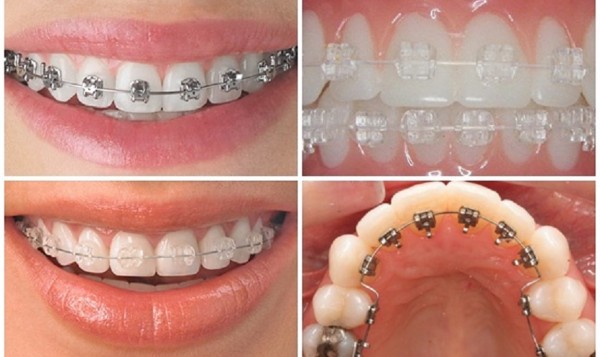 Niềng răng là phương pháp chỉnh nha nhằm điều chỉnh vị trí của răng