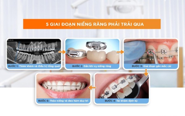 Các giai đoạn trong quá trình niềng răng