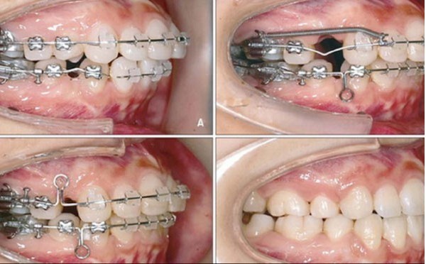 Triệu chứng và nguyên nhân trong giai đoạn xấu nhất khi niềng răng