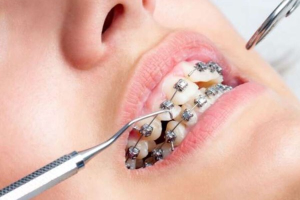 Những đối tượng dễ gặp khó khăn nhất trong giai đoạn xấu nhất khi niềng răng