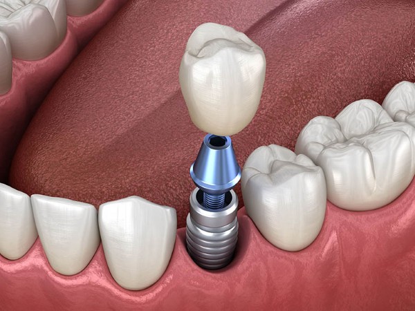 Trồng răng implant là một phương pháp phục hình răng