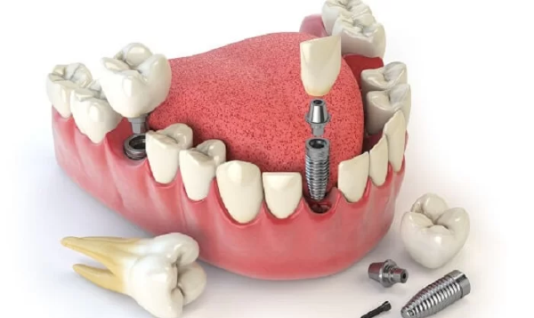 Lựa chọn đúng thời điểm để trồng răng implant giúp tăng độ bền của implant 