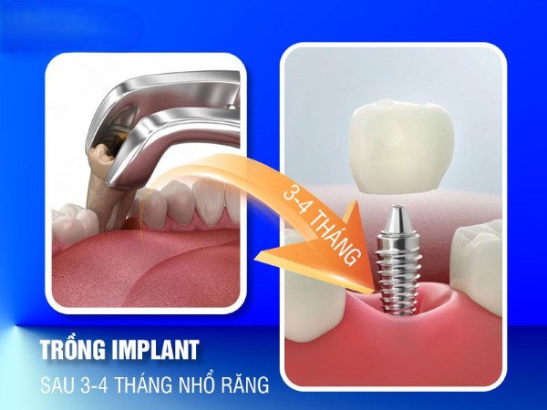 Trồng implant sau 3–4 tháng