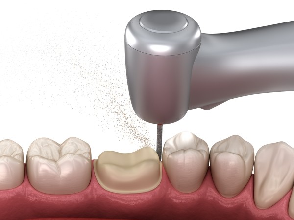 Mài răng bọc sứ là gì?