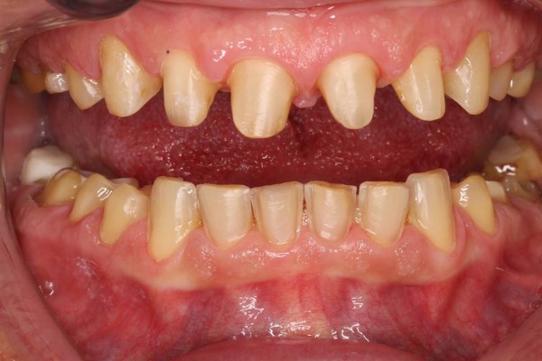 Ảnh hưởng của mài răng bọc sứ đến răng thật và sức khỏe răng miệng
