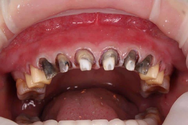 Những trường hợp nên thận trọng hoặc tránh mài răng bọc sứ