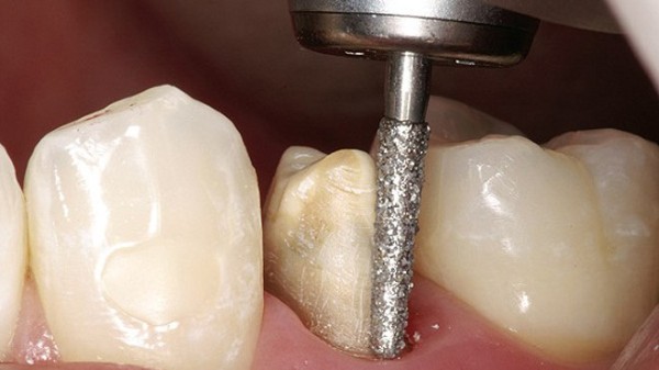 Cách phòng tránh rủi ro khi mài răng bọc sứ