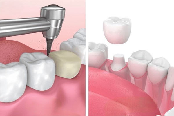 Các câu hỏi thường gặp về mài răng bọc sứ có ảnh hưởng gì không?