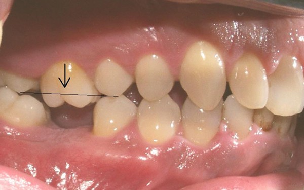 Tổng quan về thực trạng mất răng lâu năm