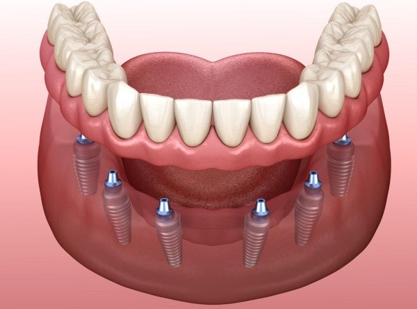 Một số điều kiện cấy ghép implant cho mất răng lâu năm