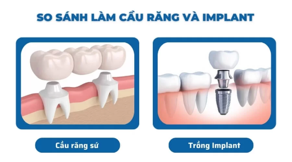 Cấy ghép Implant so với cầu răng sứ