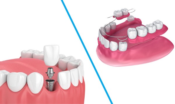 Cấy ghép Implant so với hàm giả tháo lắp