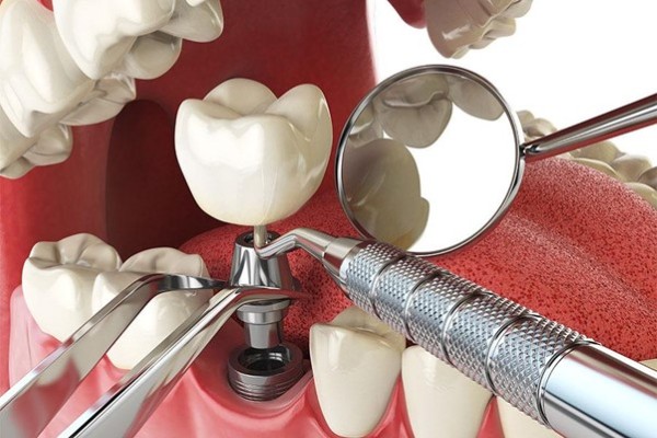 Quy trình cấy ghép implant cho người mất răng lâu năm