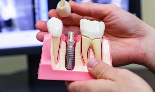 Lợi ích vượt trội và rủi ro khi trồng implant cho mất răng lâu năm