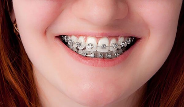 Niềng răng là phương pháp chỉnh nha phổ biến