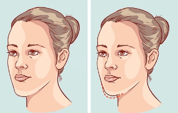 Niềng răng và cơ chế tác động của nó đến khuôn mặt