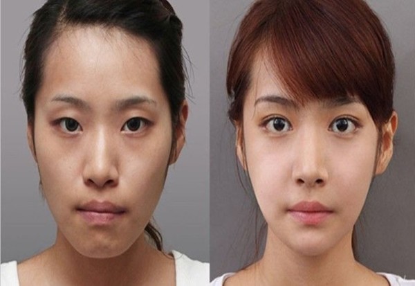 Niềng răng có làm thay đổi khuôn mặt không?