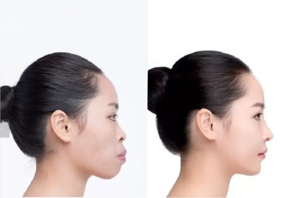 Khuôn mặt sau khi niềng răng hô