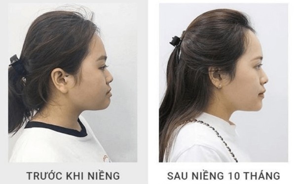 Những yếu tố ảnh hưởng tới kết quả thẩm mỹ khuôn mặt khi niềng răng