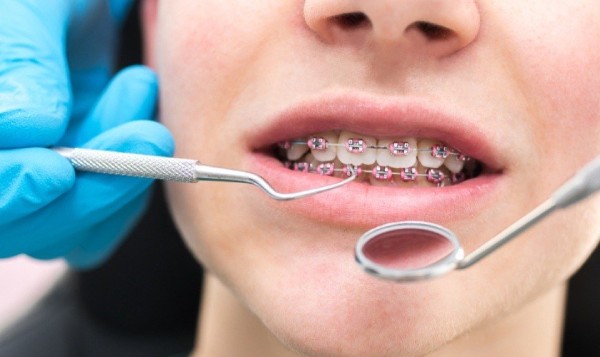 Lưu ý và cảnh báo quan trọng để tối ưu thẩm mỹ khuôn mặt niềng răng